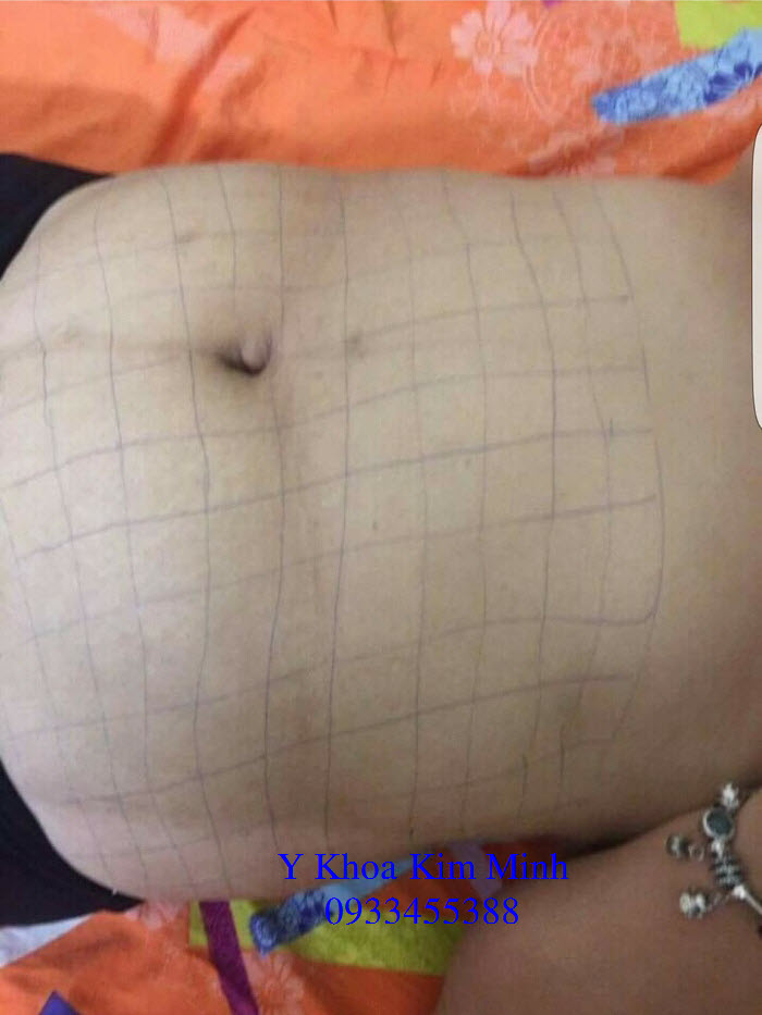 Chat tiem chich lipolytic solution phan giai mo nhap khau ban tai Y Khoa Kim Minh