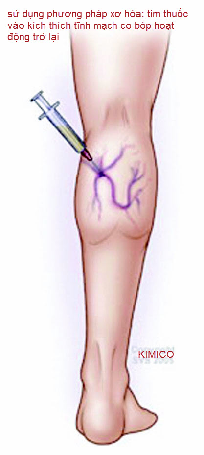 Điều trị suy gi&atilde;n tĩnh mạch ch&acirc;n v&agrave; vớ y khoa