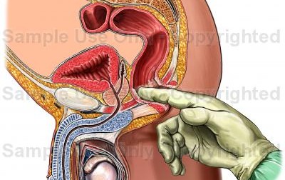 Chữa trị vi&ecirc;m tuyến tiền liệt, vi&ecirc;m b&agrave;ng quang, u xơ tử cung