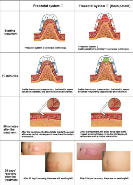 M&aacute;y giảm b&eacute;o quang đ&ocirc;ng ETG50-4S