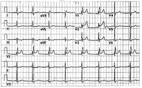 điện t&acirc;m đồ bằng m&aacute;y điện tim ECG