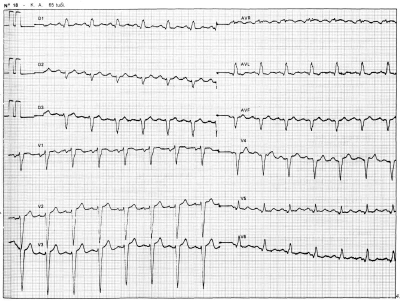 m&aacute;y điện tim ph&aacute;t hiện nhồi m&aacute;u cơ, vi&ecirc;m tim