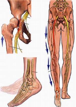 chữa đau thần kinh tọa anh Minh 0903319443