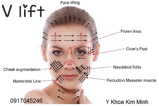 Gia chi vang 4D Ultra V lift Han quoc phan phoi Y Khoa Kim Minh