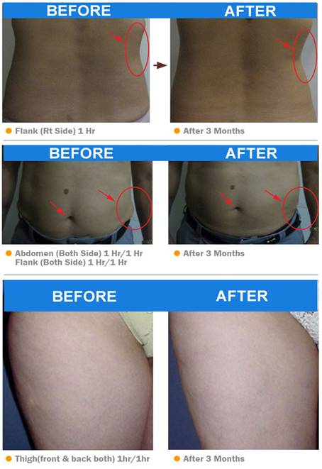 Giảm b&eacute;o c&ocirc;ng nghệ quang đ&ocirc;ng cryolipolysis