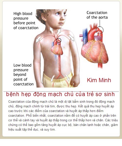 Bệnh hẹp động mạch chủ của trẻ sơ sinh