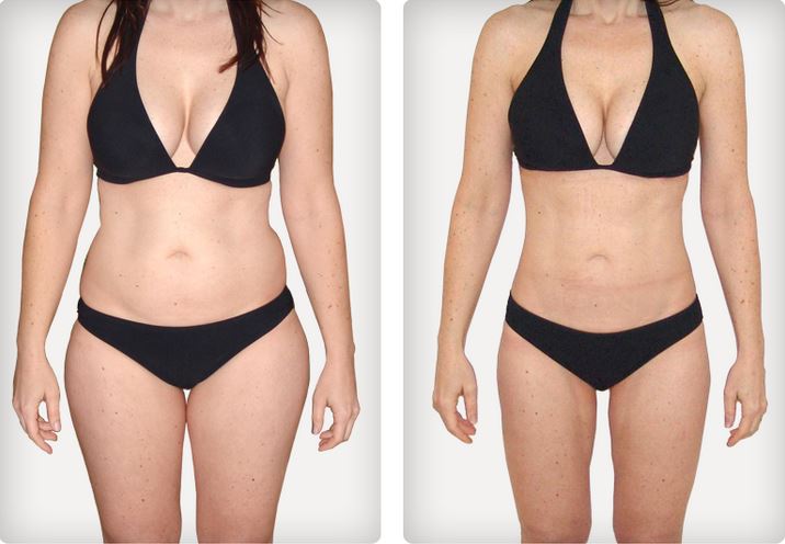 hoc cang da tieu mo bung bang chi Tri Lipo Cog Filler Cog Han Quoc Y khoa Kim Minh