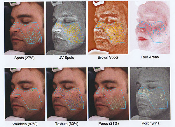M&aacute;y soi da kết nối m&aacute;y vi t&iacute;nh, c&aacute;ch sử dụng đầu soi m&aacute;y soi da B-326C Y khoa Kim Minh