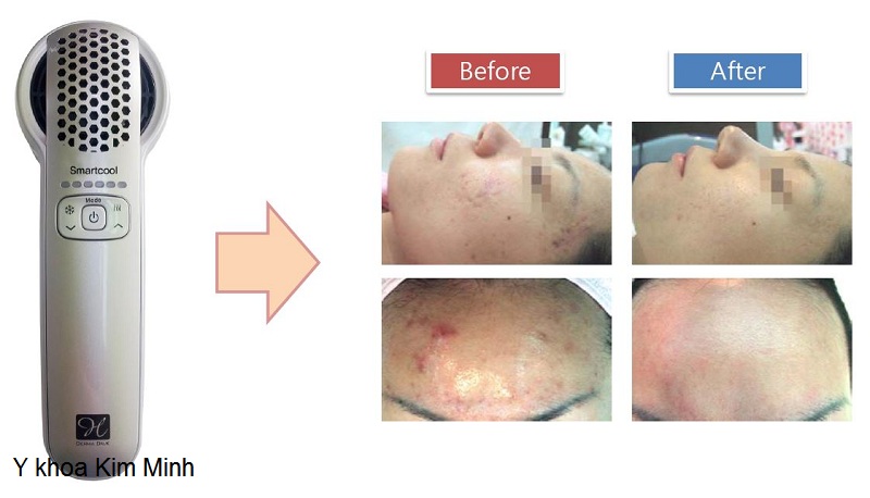 May di di day serum te bao goc mini Smartcool Y Khoa Kim Minh ban si 