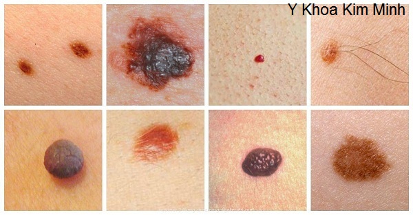 May dot mun thit not ruoi mini cam tay Y Khoa Kim Minh