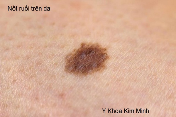 May dot not ruoi xoa nam tan nhang mun thit Y Khoa Kim Minh