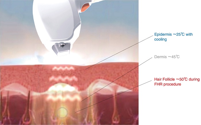 May triet long nhanh va manh nhat Diode Laser KM-808 tri nam tre hoa da Y khoa Kim Minh