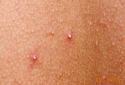 Mụn đầu trắng