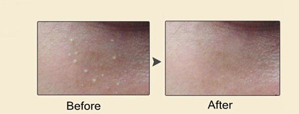 May dot mun thi not ruoi tang nhang xoa nam cam tay mini ca nhan Y Khoa Kim Minh