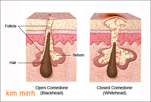 Mụn trứng cá và cách điều trị