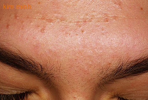 Mụn trứng cá do viêm nang lông