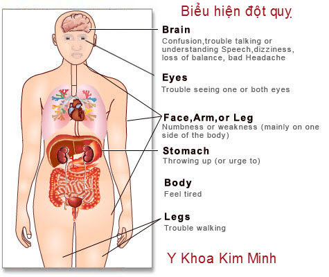 bệnh đột quỵ và cách nhận biết