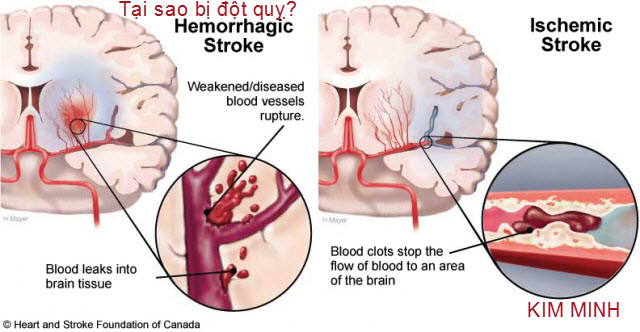 Đột quỵ, các triệu chứng và phòng chống đột quỵ