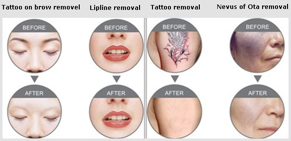 Máy laser YAG xóa xăm trị sắc tố đậm trên da