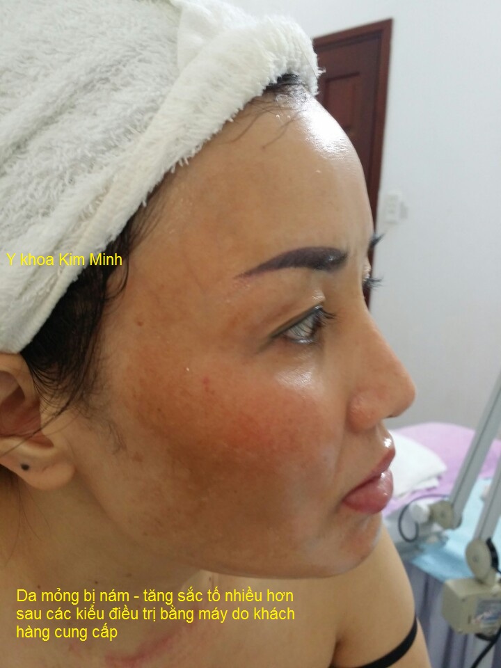 Cham soc dieu tri da nam mong voi tao silic song b-tox matrigen han quoc Y khoa Kim Minh