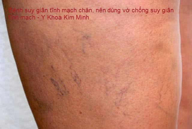 bệnh suy gi&atilde;n tĩnh mạch v&agrave; suy tĩnh mạch mạng nhện