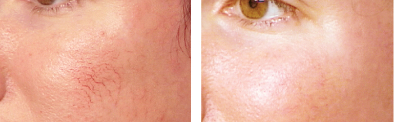 bệnh suy tĩnh mạch v&agrave; suy tĩnh mạch mạng nhện