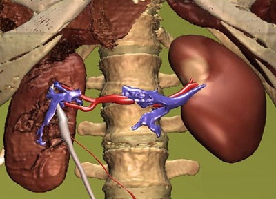 Lựa chọn thực phẩm cho người suy thận