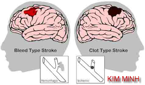 cơn đột quỵ là gì