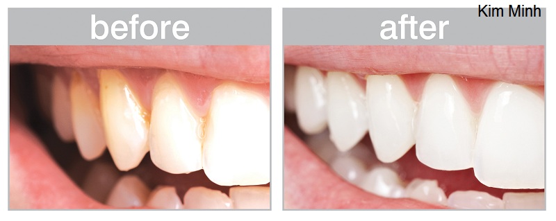 Phuong phap laser tay trang rang bang anh sang laser TW-4 Y khoa Kim Minh