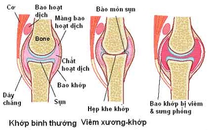 Chữa vi&ecirc;m đau nhứt đầu gối khớp KIM MINH
