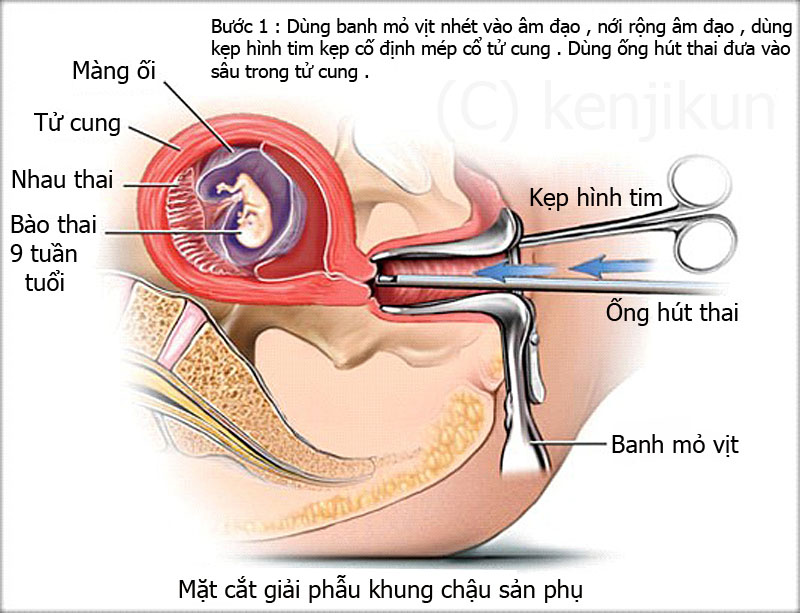 Thìa nạo tự cung inox Y Khoa Kim Minh