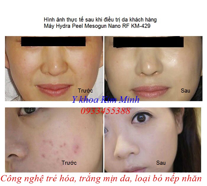 Hình ảnh trước và sau điều trị máy Hydra Peel Mesogun Nano RF KM-429 - Y Khoa Kim Minh