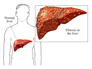 ung thư gan do nhiễm si&ecirc;u vi v&agrave; 6 loại ung thư phổ biến