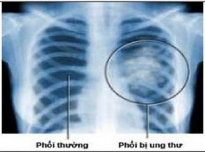 Ung thư phổi v&agrave; 6 loại ung thư phổ biến nhất