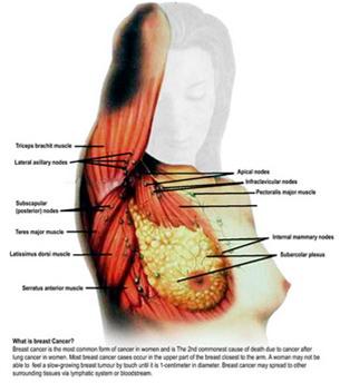 ung thư v&uacute; v&agrave; 6 loại ung thu phổ biến