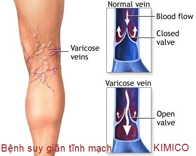 bệnh suy gi&atilde;n tĩnh mạch ch&acirc;n